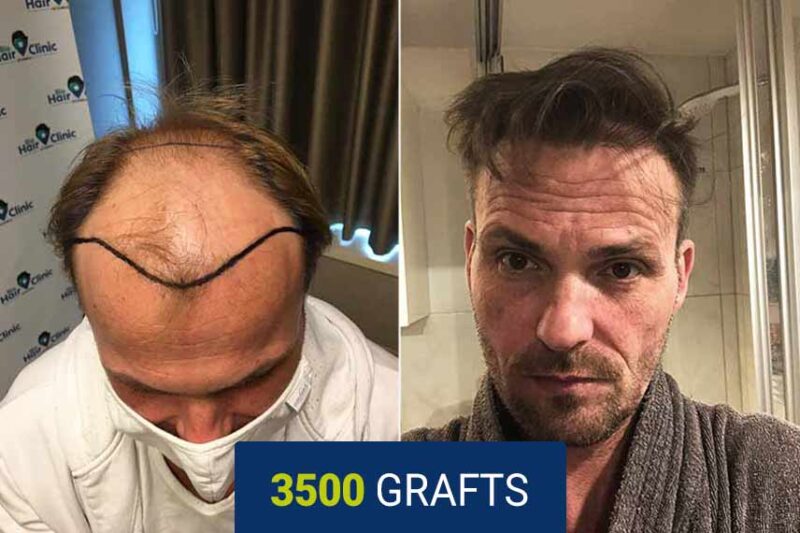 Before and after results
